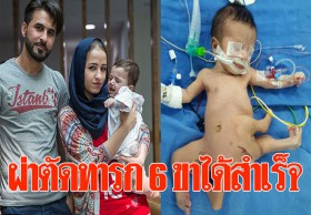 แพทย์อินเดียเจ๋ง ผ่าตัดทารก 6 ขาได้สำเร็จครั้งแรกในโลก